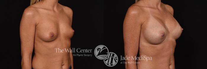 Before & After Breast Augmentation Case 766 VIEW #2 View in Shreveport, LA