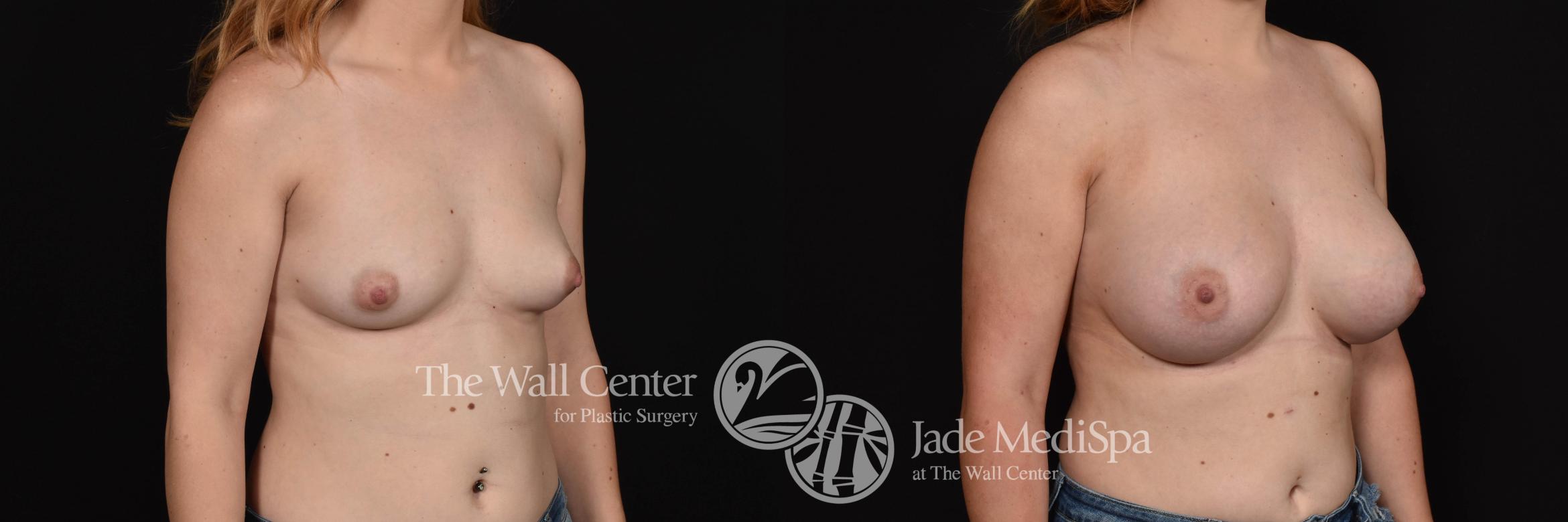 Before & After Breast Augmentation Case 768 VIEW #2 View in Shreveport, LA