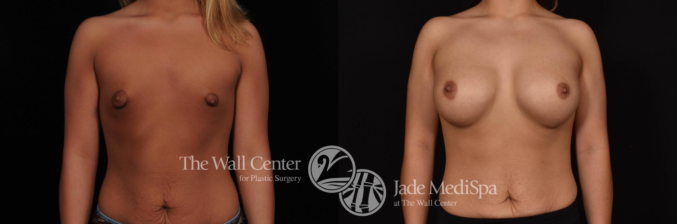 Before & After Breast Augmentation Case 769 VIEW #1 View in Shreveport, LA