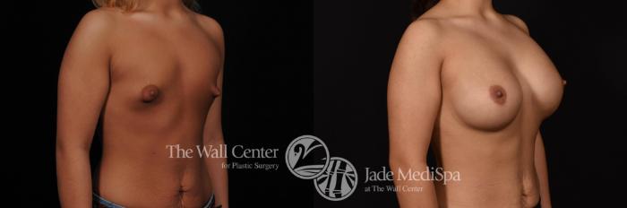 Before & After Breast Augmentation Case 769 VIEW #2 View in Shreveport, LA
