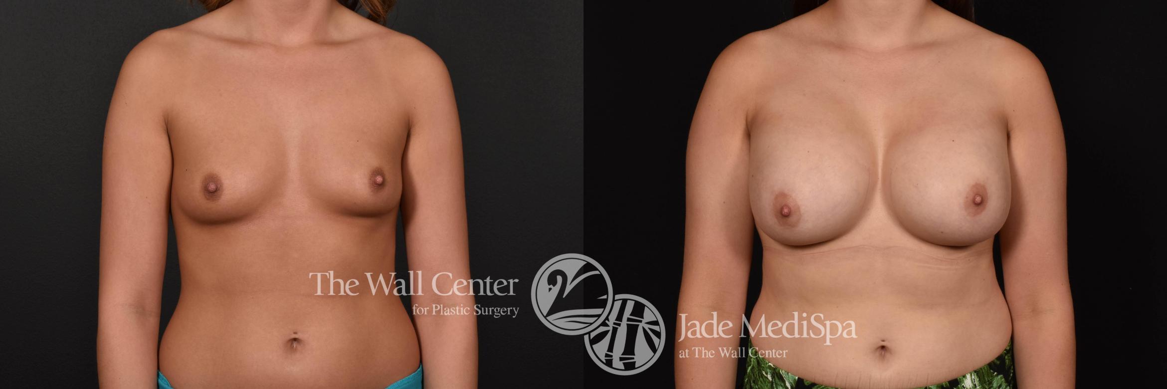 Before & After Breast Augmentation Case 771 VIEW #1 View in Shreveport, LA