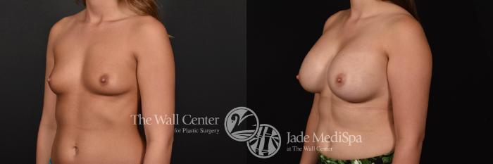 Before & After Breast Augmentation Case 771 VIEW #2 View in Shreveport, LA