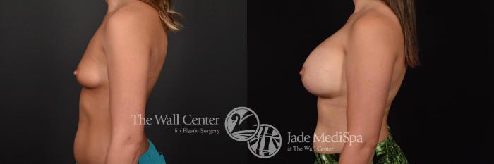 Before & After Breast Augmentation Case 771 VIEW #3 View in Shreveport, LA