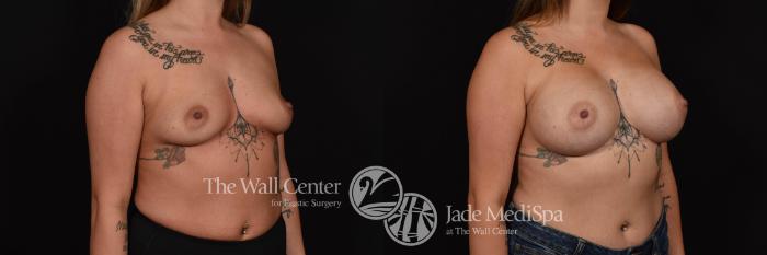 Before & After Breast Augmentation Case 772 VIEW #2 View in Shreveport, LA