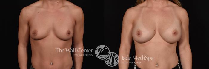 Before & After Breast Augmentation Case 774 VIEW #1 View in Shreveport, LA