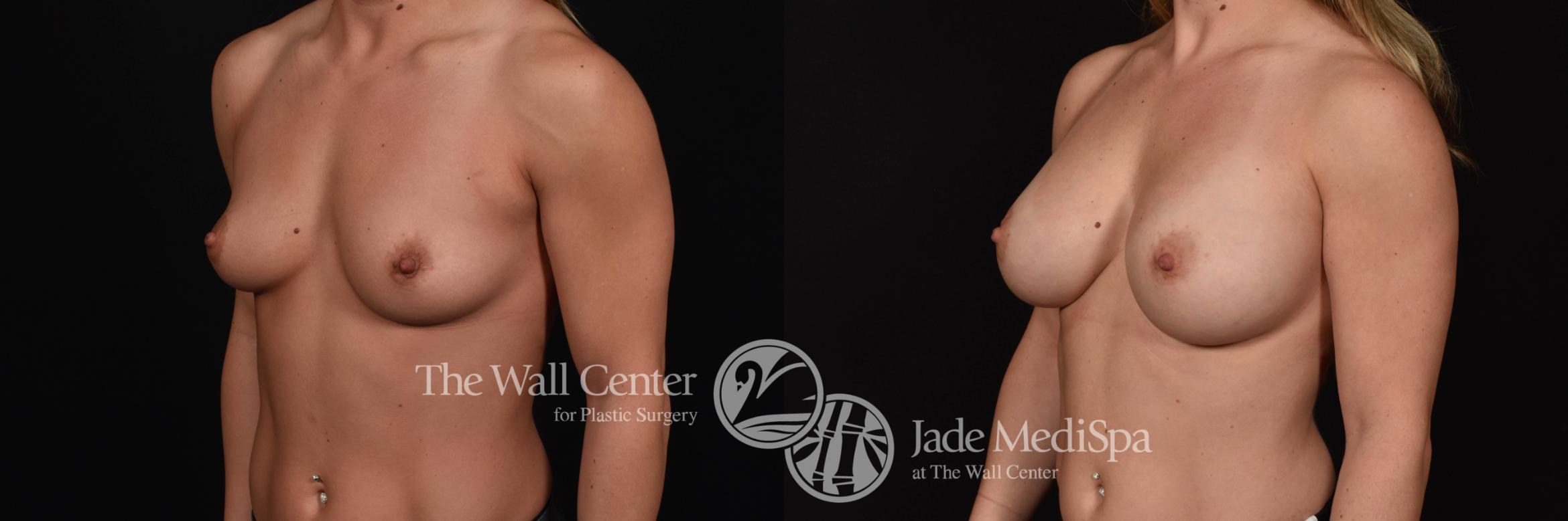 Before & After Breast Augmentation Case 774 VIEW #2 View in Shreveport, LA