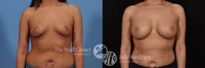 Before & After Breast Augmentation Case 777 VIEW #1 View in Shreveport, LA