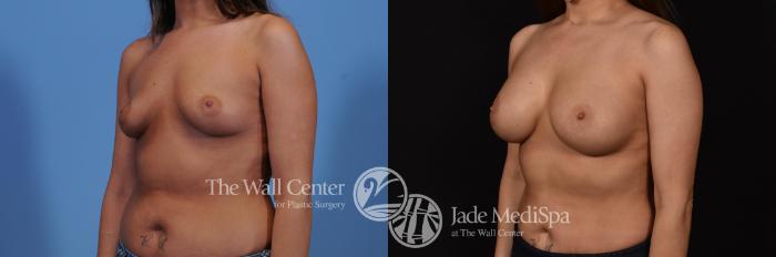 Before & After Breast Augmentation Case 777 VIEW #2 View in Shreveport, LA