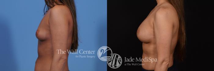 Before & After Breast Augmentation Case 777 VIEW #3 View in Shreveport, LA