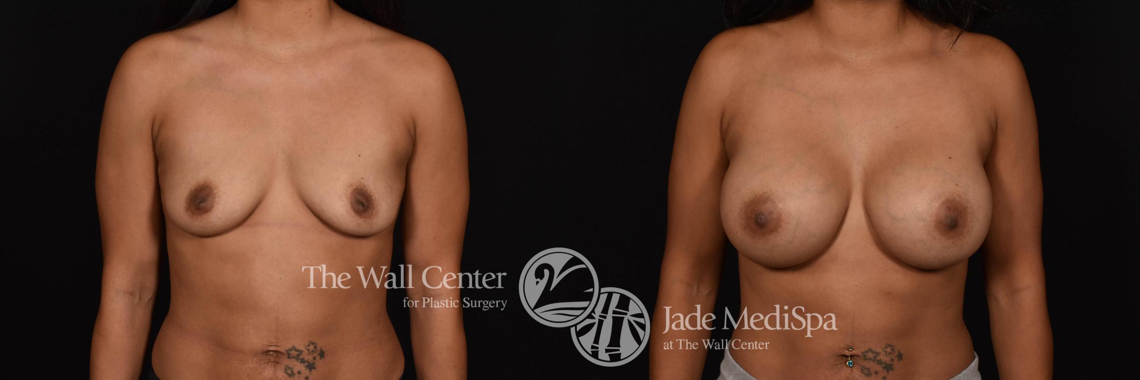 Before & After Breast Augmentation Case 778 VIEW #1 View in Shreveport, LA