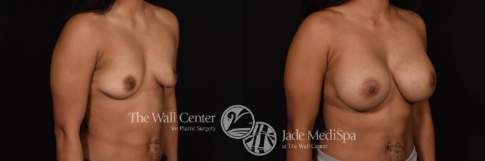 Before & After Breast Augmentation Case 778 VIEW #2 View in Shreveport, LA
