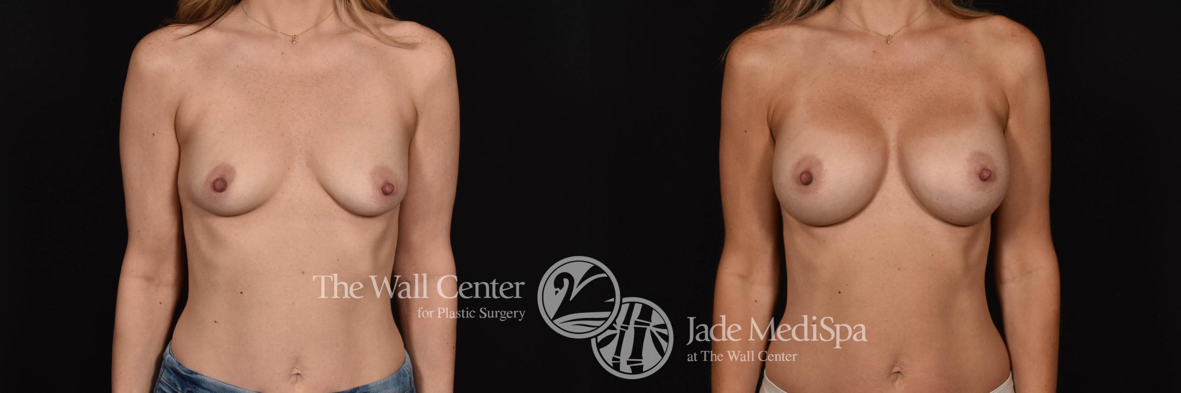 Before & After Breast Augmentation Case 782 VIEW #1 View in Shreveport, LA