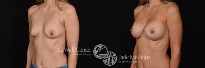 Before & After Breast Augmentation Case 782 VIEW #2 View in Shreveport, LA