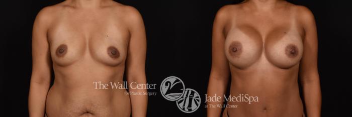Before & After Breast Augmentation Case 783 VIEW #1 View in Shreveport, LA