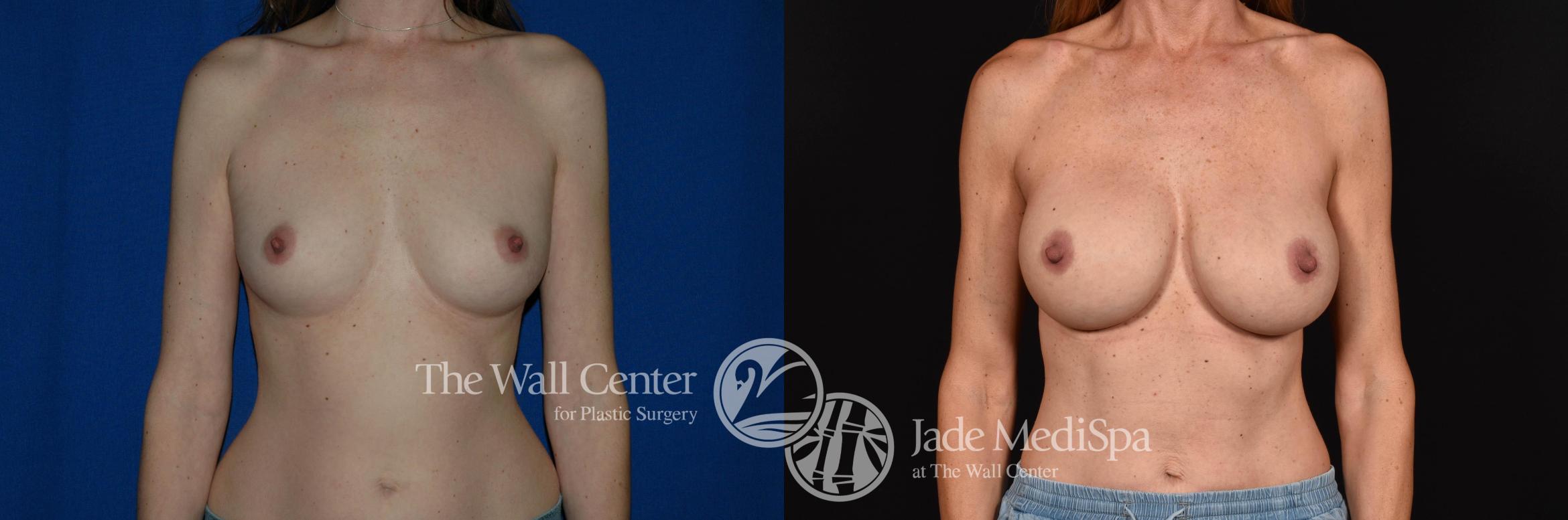 Before & After Breast Augmentation Case 787 VIEW #1 View in Shreveport, LA