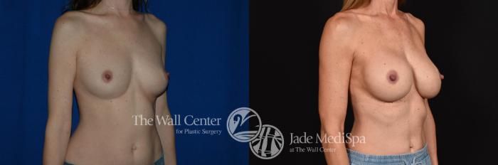 Before & After Breast Augmentation Case 787 VIEW #2 View in Shreveport, LA