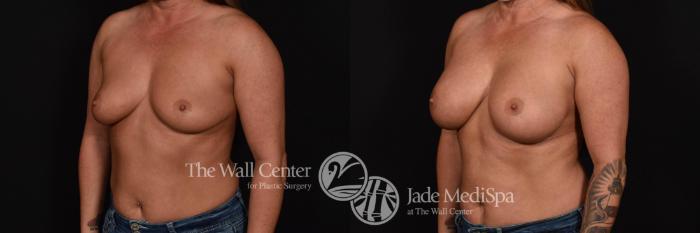 Before & After Breast Augmentation Case 791 VIEW #2 View in Shreveport, LA