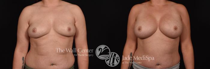 Before & After Breast Augmentation Case 795 VIEW #1 View in Shreveport, LA