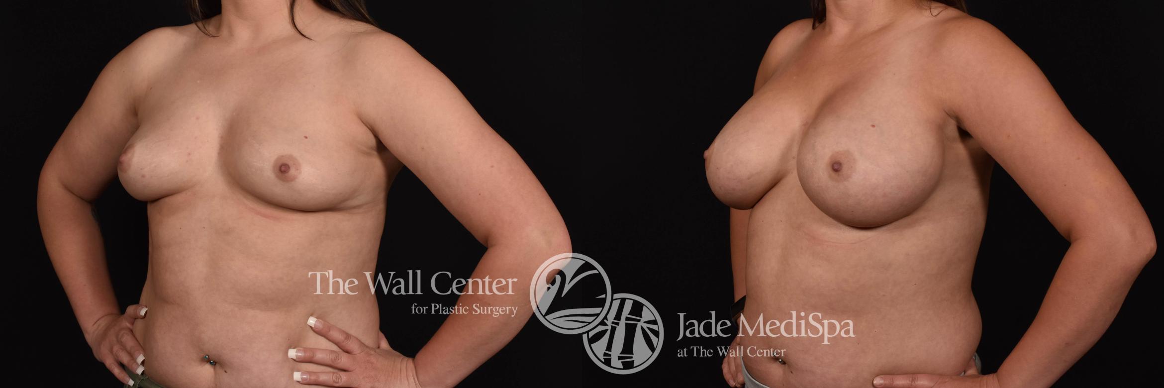 Before & After Breast Augmentation Case 795 VIEW #2 View in Shreveport, LA