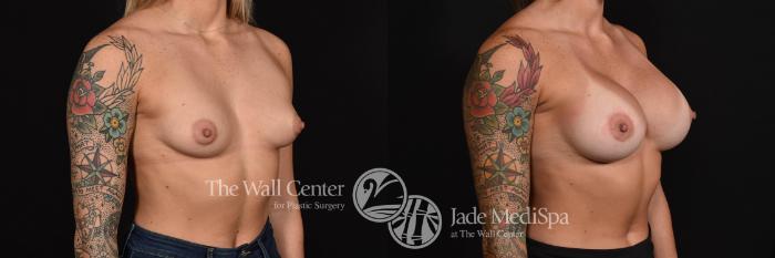 Before & After Breast Augmentation Case 797 VIEW #2 View in Shreveport, LA