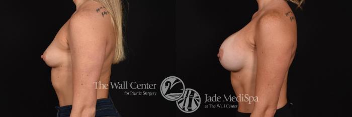 Before & After Breast Augmentation Case 797 VIEW #3 View in Shreveport, LA
