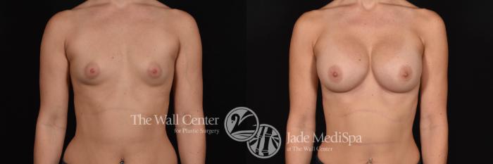 Before & After Breast Augmentation Case 800 VIEW #1 View in Shreveport, LA