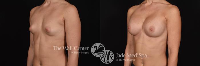 Before & After Breast Augmentation Case 800 VIEW #2 View in Shreveport, LA