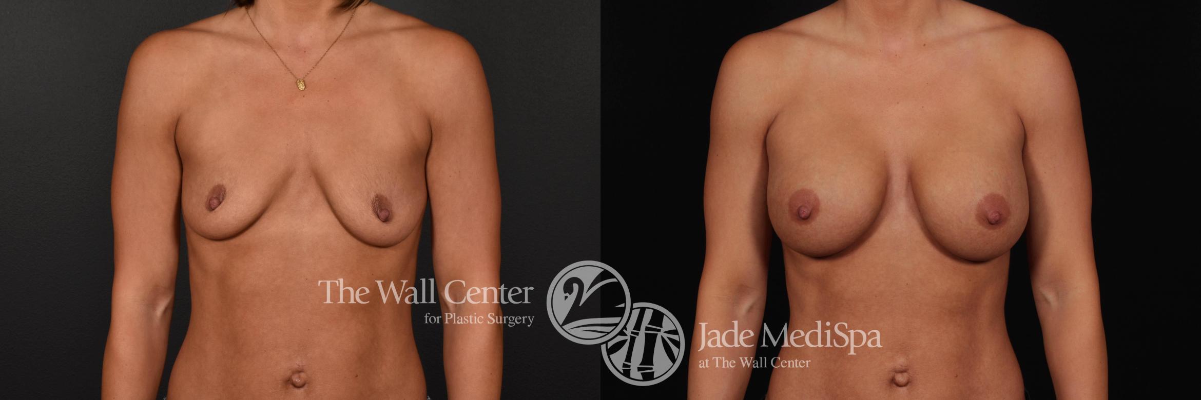 Before & After Breast Augmentation Case 802 VIEW #1 View in Shreveport, LA