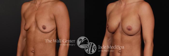 Before & After Breast Augmentation Case 802 VIEW #2 View in Shreveport, LA