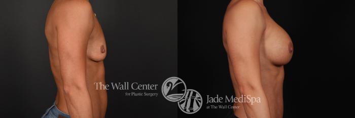 Before & After Breast Augmentation Case 802 VIEW #3 View in Shreveport, LA
