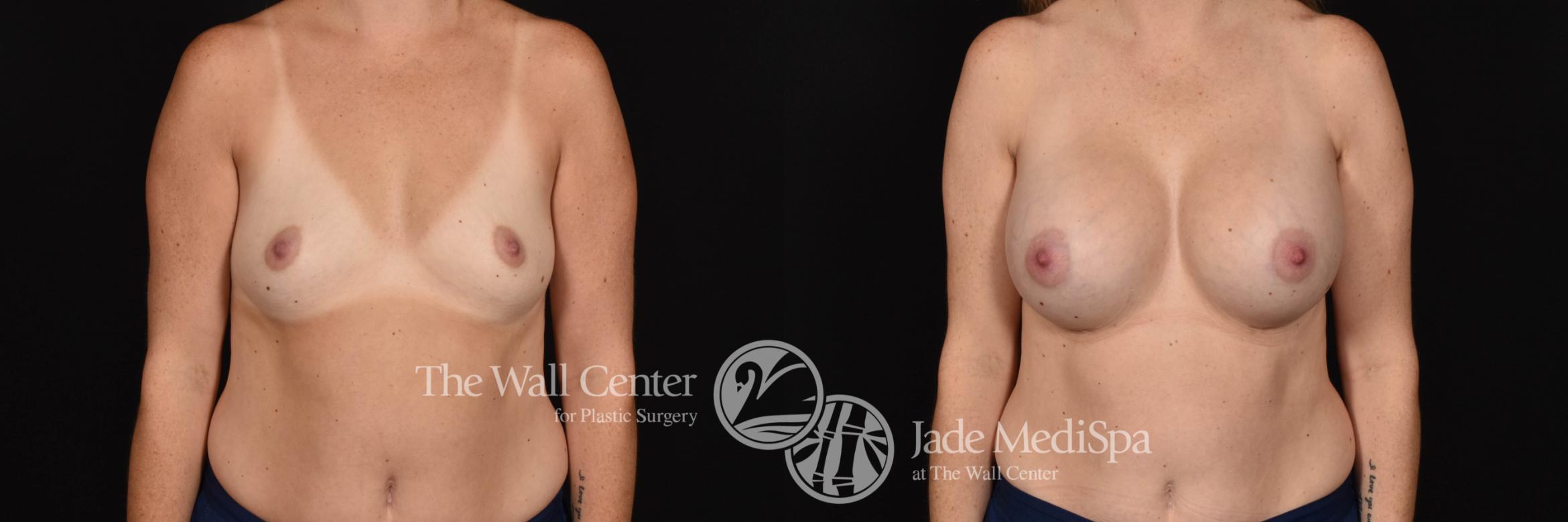 Breast Augmentation Front Photo, Shreveport, Louisiana, The Wall Center for Plastic Surgery, Case 815