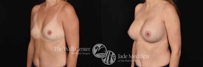 Breast Augmentation Left Oblique Photo, Shreveport, Louisiana, The Wall Center for Plastic Surgery, Case 815