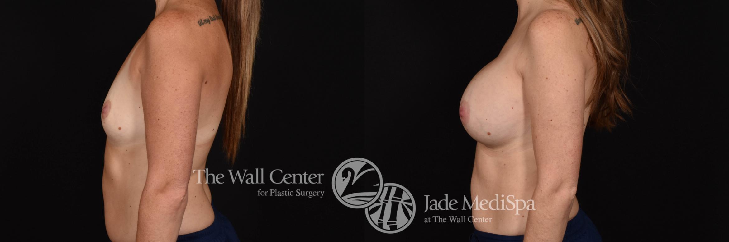 Breast Augmentation Left Side Photo, Shreveport, Louisiana, The Wall Center for Plastic Surgery, Case 815