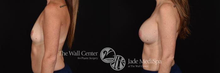 Breast Augmentation Left Side Photo, Shreveport, Louisiana, The Wall Center for Plastic Surgery, Case 815
