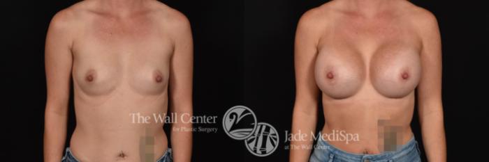 Breast Augmentation Front Photo, Shreveport, Louisiana, The Wall Center for Plastic Surgery, Case 816