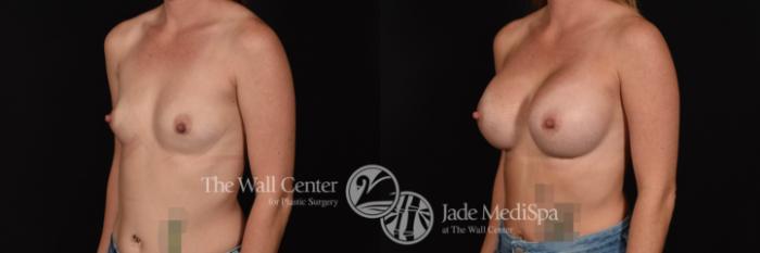 Breast Augmentation Left Oblique Photo, Shreveport, Louisiana, The Wall Center for Plastic Surgery, Case 816