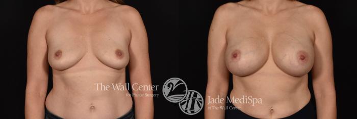Breast Augmentation Front Photo, Shreveport, Louisiana, The Wall Center for Plastic Surgery, Case 820