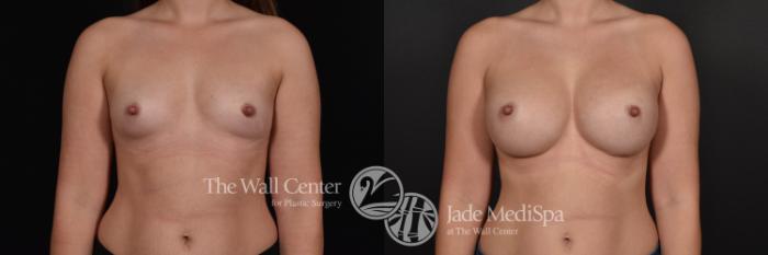Breast Augmentation Front Photo, Shreveport, Louisiana, The Wall Center for Plastic Surgery, Case 823
