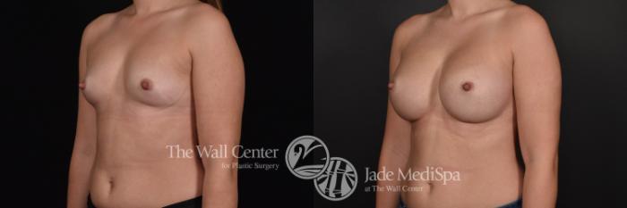 Breast Augmentation Left Oblique Photo, Shreveport, Louisiana, The Wall Center for Plastic Surgery, Case 823