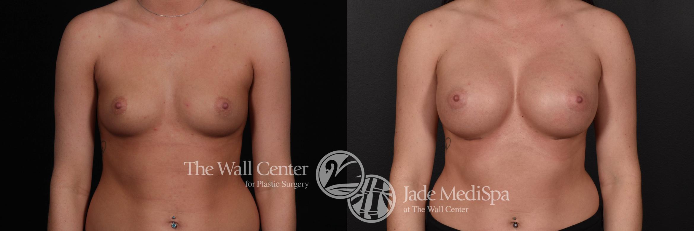 Breast Augmentation Front Photo, Shreveport, Louisiana, The Wall Center for Plastic Surgery, Case 824