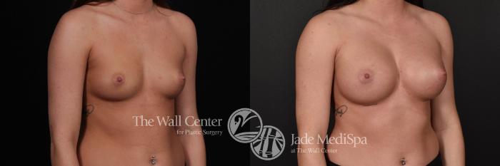 Breast Augmentation Right Oblique Photo, Shreveport, Louisiana, The Wall Center for Plastic Surgery, Case 824