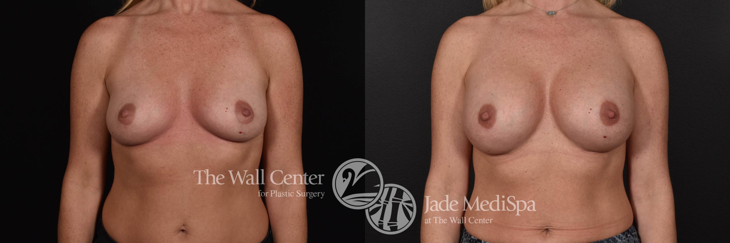 Breast Augmentation Front Photo, Shreveport, Louisiana, The Wall Center for Plastic Surgery, Case 829