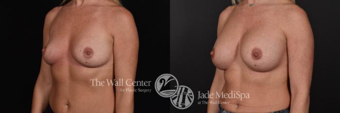 Breast Augmentation Left Oblique Photo, Shreveport, Louisiana, The Wall Center for Plastic Surgery, Case 829