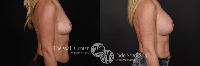 Breast Augmentation Right Side Photo, Shreveport, Louisiana, The Wall Center for Plastic Surgery, Case 829