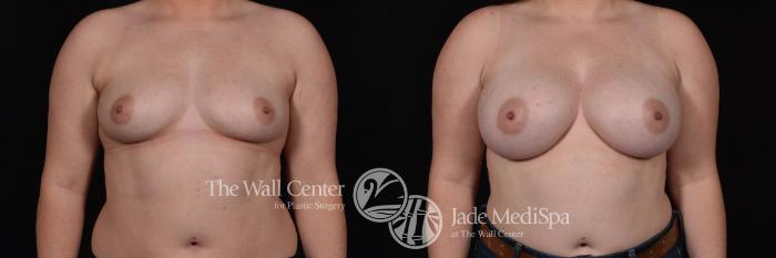 Breast Augmentation Front Photo, Shreveport, Louisiana, The Wall Center for Plastic Surgery, Case 832