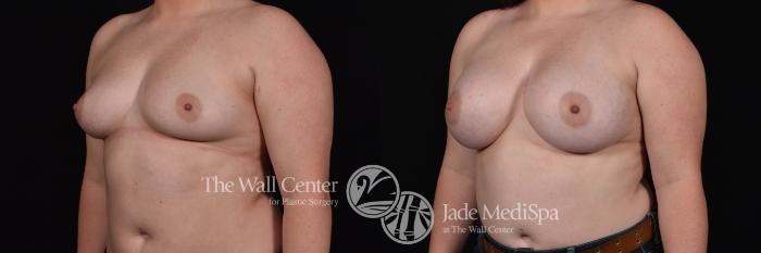 Breast Augmentation Left Oblique Photo, Shreveport, Louisiana, The Wall Center for Plastic Surgery, Case 832