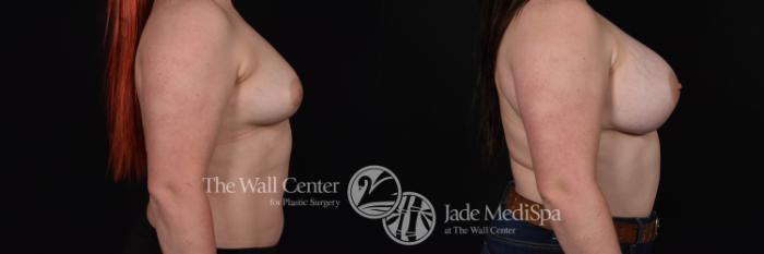 Breast Augmentation Right Side Photo, Shreveport, Louisiana, The Wall Center for Plastic Surgery, Case 832