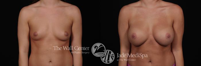 Breast Augmentation Front Photo, Shreveport, Louisiana, The Wall Center for Plastic Surgery, Case 841