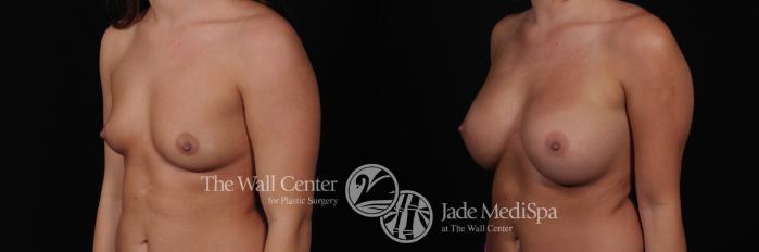 Breast Augmentation Left Oblique Photo, Shreveport, Louisiana, The Wall Center for Plastic Surgery, Case 841