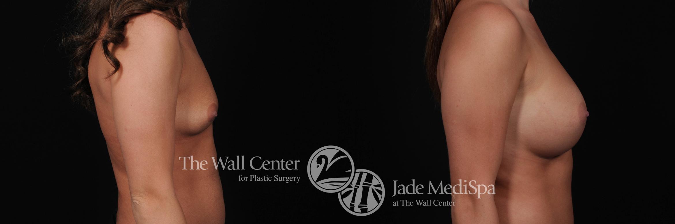 Breast Augmentation Front Photo, Shreveport, Louisiana, The Wall Center for Plastic Surgery, Case 841